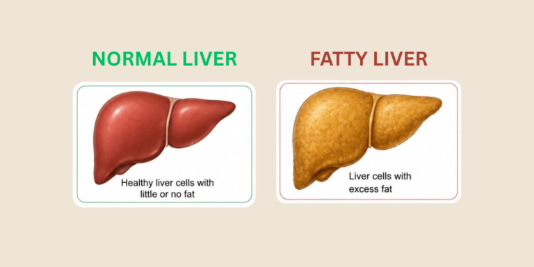 FATTY LIVER DISEASE